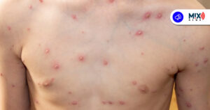 Más de 800 Casos de varicela en Aguascalientes