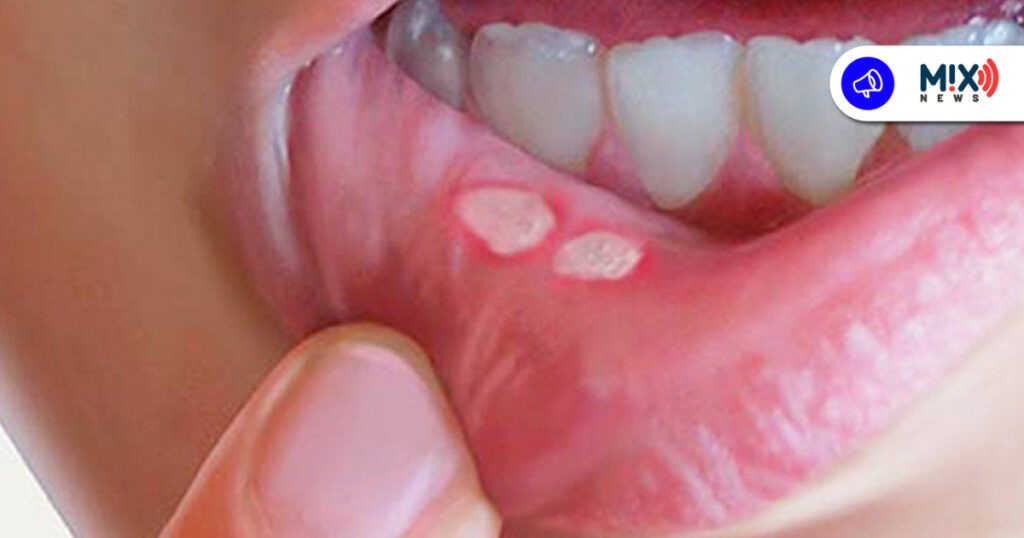 Alertan por aumento en casos de sífilis