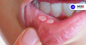 Alertan por aumento en casos de sífilis