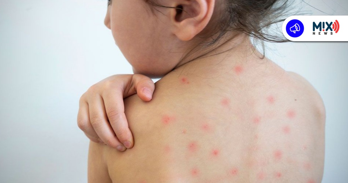 Activan protocolos sanitarios por posible caso de sarampión en menor de 10 años