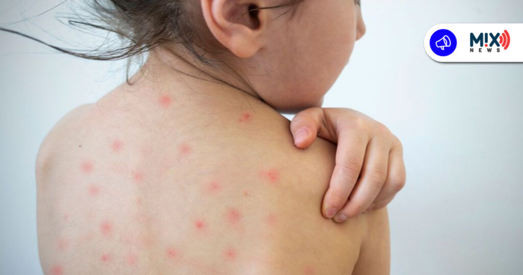 Otro contagio de sarampión en Aguascalientes