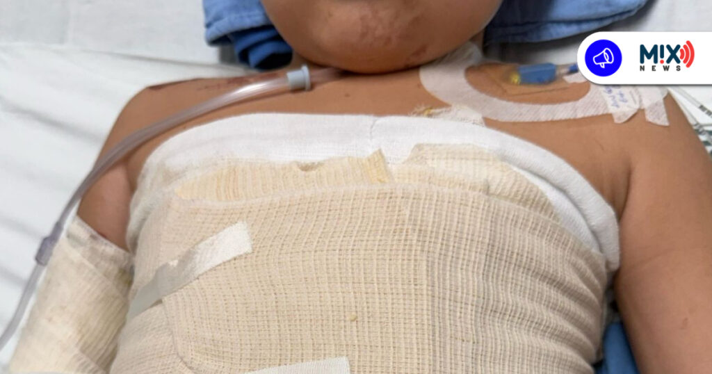 IMSS Aguascalientes salvó a niño con quemaduras; será atendido en California