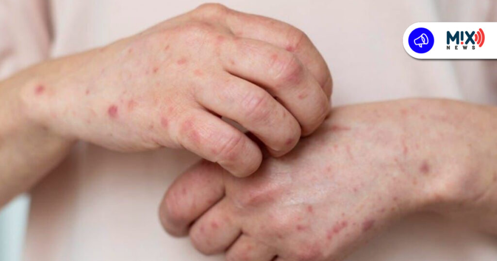 Ya van 5 casos de sarampión en Aguascalientes