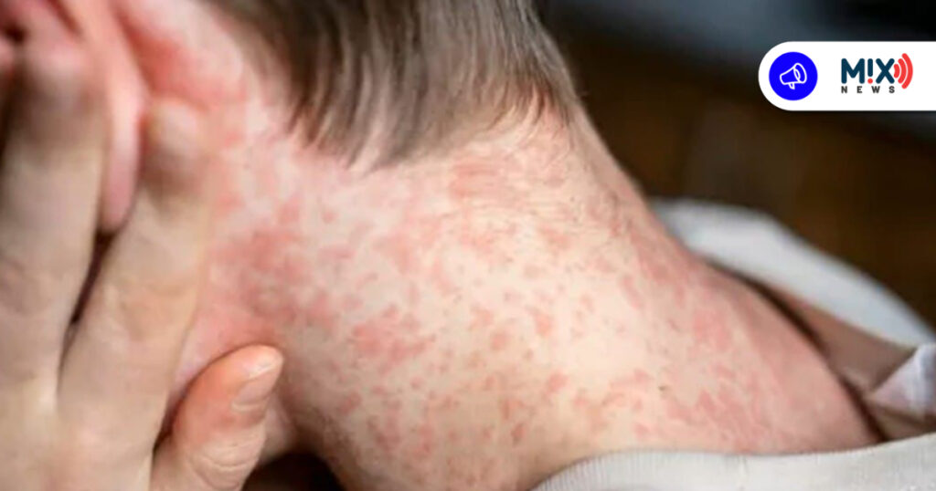 Ya van 8 casos de sarampión en Aguascalientes